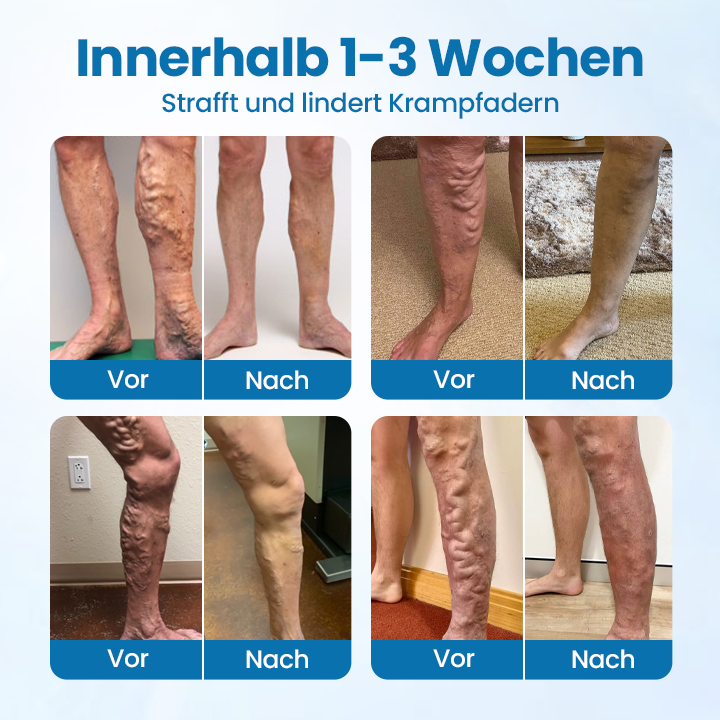 🎁Ourlyard® VeinGuard Kräuterspray-✅Klinisch erwiesen, um Krampfadern in nur 7 Tagen zu beseitigen!!