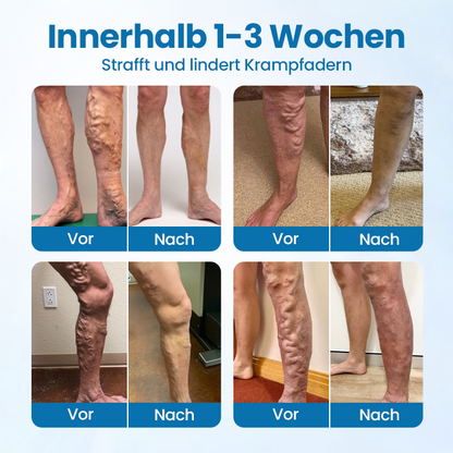 🎁Ourlyard® VeinGuard Kräuterspray-✅Klinisch erwiesen, um Krampfadern in nur 7 Tagen zu beseitigen!!