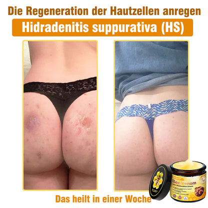🌟Hergestellt und versendet aus Deutschland💖  Ourlyard® Bienengift Hautregenerationscreme 🔥 LETZTER TAG 80 % RABATT 🌟