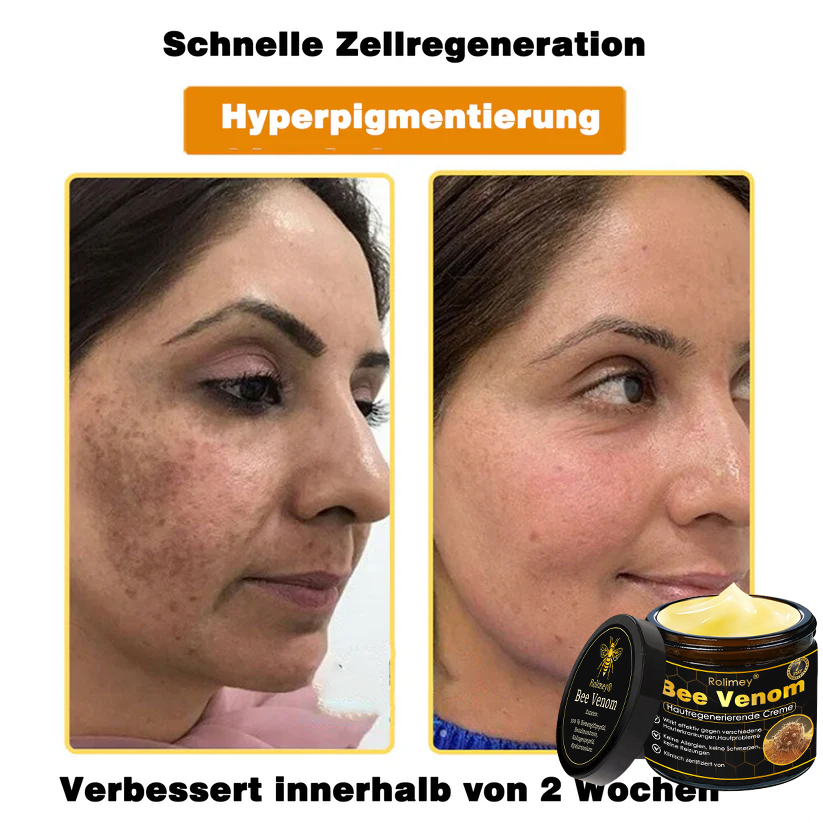 🎁🎁Neuestes Modell: Rolimey® Bienengift Max Pflegecreme – Reparatureffekt um 65 % gesteigert 🔥 NUR NOCH 80 % RABATT