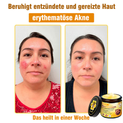 🌟Hergestellt und versendet aus Deutschland💖  Ourlyard® Bienengift Hautregenerationscreme 🔥 LETZTER TAG 80 % RABATT 🌟