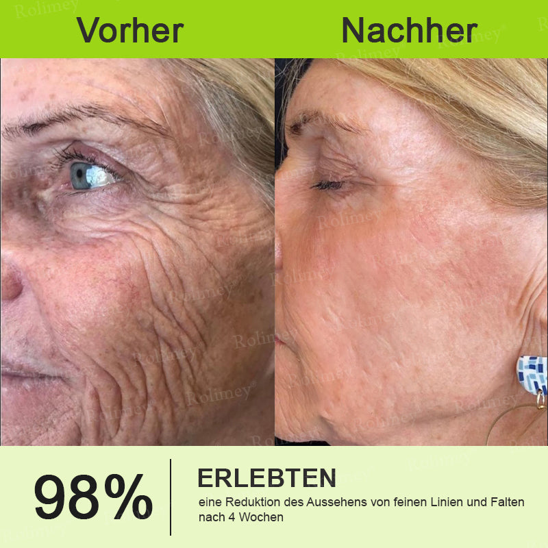 ✅Jetzt jugendliche Haut zurückgewinnen 💫Rolimey® Botox & Vita-A Retinol Shot Falten-Lift Straffungscreme