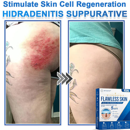 ✅ DR.Fachmer® 2-in-1 Microneedle & Hydrocolloid Patch | Raised Moles,Acne,  Flat Warts & Skin Tags Remover | Improves Wrinkles, Scars & Blemishes | Invisible Pimple Patches for Face & Body