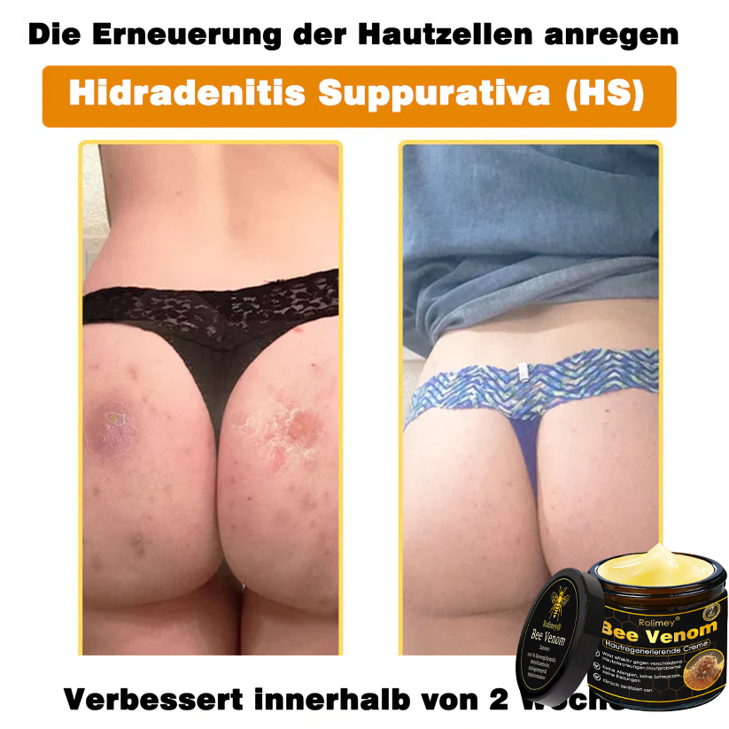 🎁🎁Neuestes Modell: Rolimey® Bienengift Max Pflegecreme – Reparatureffekt um 65 % gesteigert 🔥 NUR NOCH 80 % RABATT