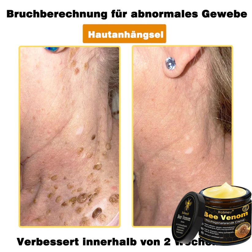 🎁🎁Neuestes Modell: Rolimey® Bienengift Max Pflegecreme – Reparatureffekt um 65 % gesteigert 🔥 NUR NOCH 80 % RABATT