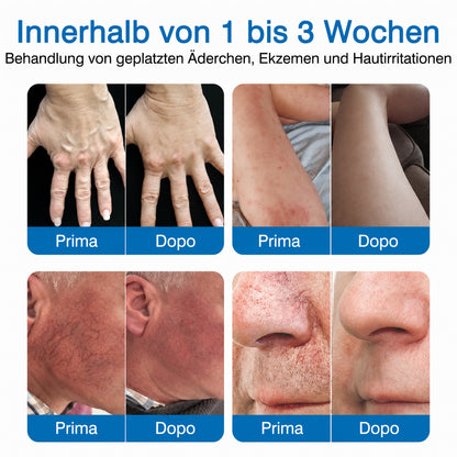 👨GFOUK® VeinRepair Mikronadel-Pflasterrolle ⚡ Sofortige Linderung, Langzeitergebnisse