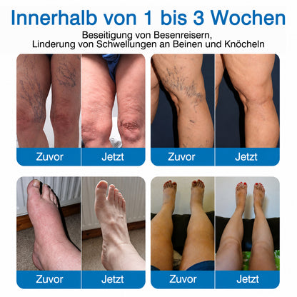 👨GFOUK® VeinRepair Mikronadel-Pflasterrolle ⚡ Sofortige Linderung, Langzeitergebnisse
