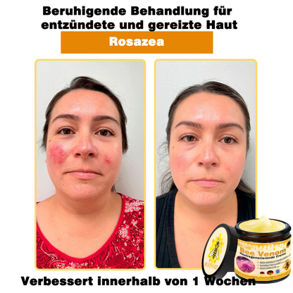 💥Ourlyard® Bienengift Pro Umfassende Creme — 💥Begrenzte Zeit 80 % RABATT💥