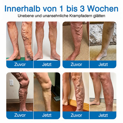 👨GFOUK® VeinRepair Mikronadel-Pflasterrolle ⚡ Sofortige Linderung, Langzeitergebnisse