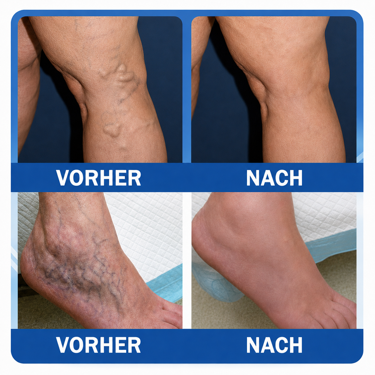 🏥DR.Fachmer® Mikronadel-Pflaster VeinRepair ⚡ Sofortige Entlastung & langfristige Ergebnisse für müde Beine