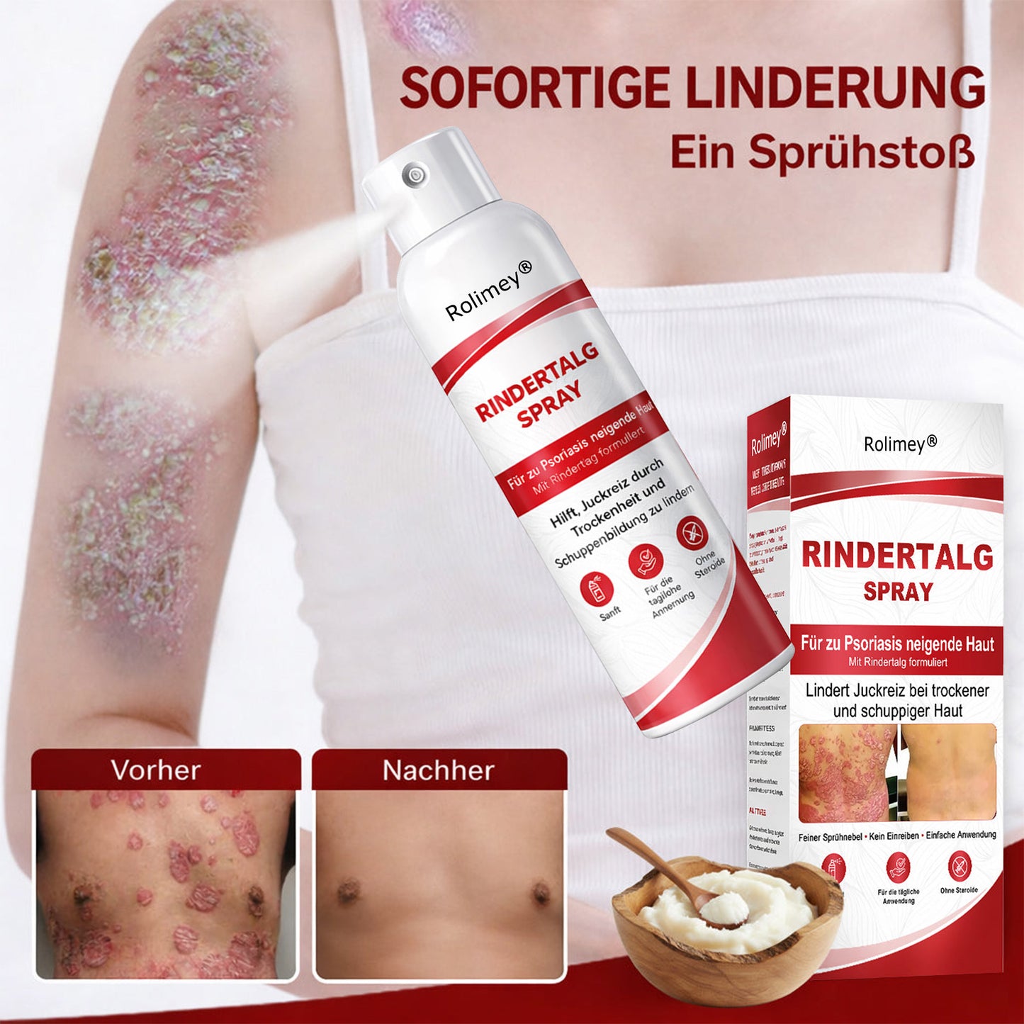 Rolimey® Rindertalg-Spray für juckende, schuppige Psoriasis-Haut 1