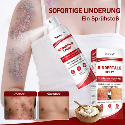 Rolimey® Rindertalg-Spray für juckende, schuppige Psoriasis-Haut 1