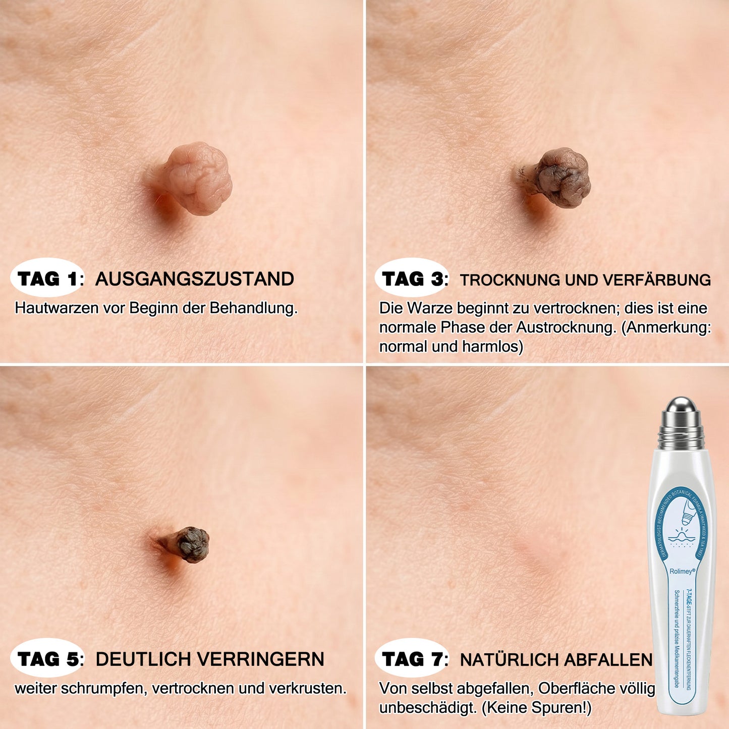 Rolimey® 7-Tage Tag- & Spot-Entferner🤍 (𝐙𝗲𝗿𝗼 𝐏𝗮𝗶𝗻, 𝐙𝗲𝗿𝗼 𝐒𝗰𝗮𝗿𝘀 Roll-On) ✅ Geeignet für: Hauttags, Flecken, Muttermale, Warzen, Blasen, Ekzeme, Schuppen, Hautkeratosen, Akne, Hautwucherungen, Narben, Geburtstagsmale 👩‍⚕️