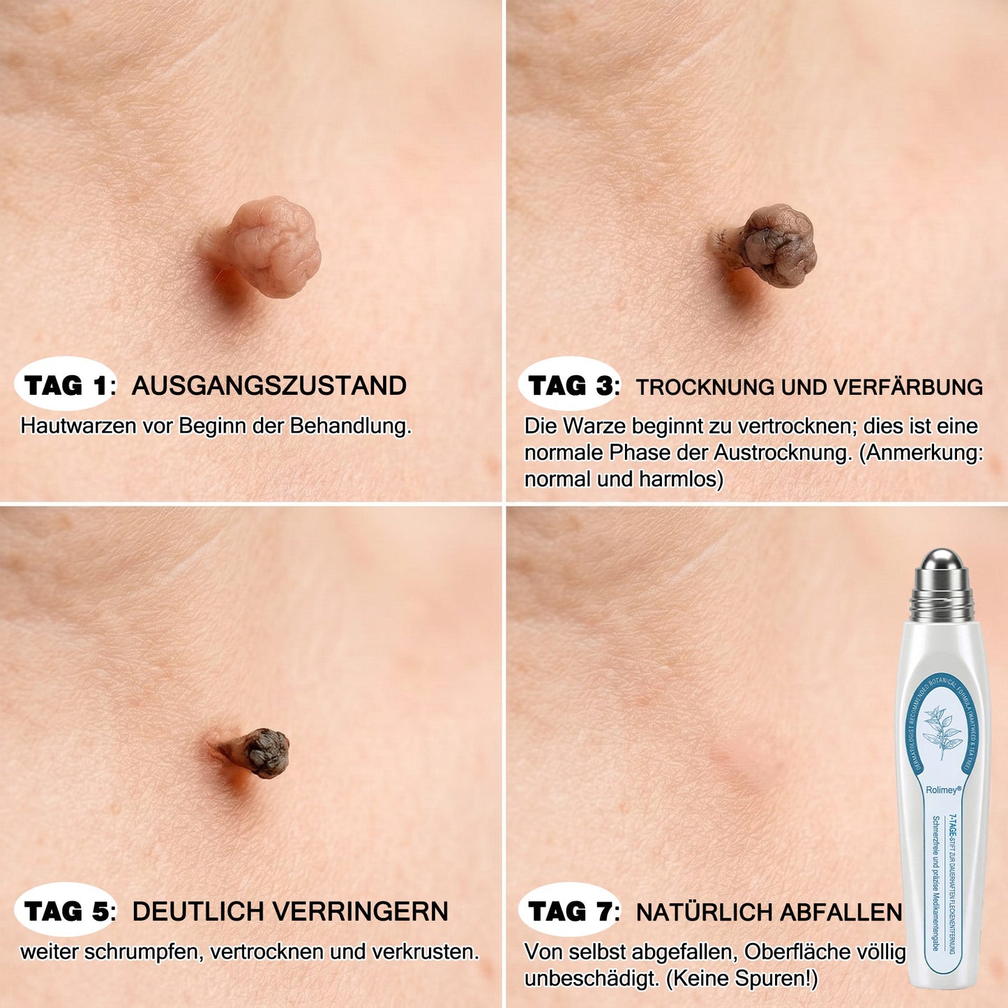 Rolimey® 7-Tage Tag- & Spot-Entferner🆕 (𝐙𝗲𝗿𝗼 𝐏𝗮𝗶𝗻, 𝐙𝗲𝗿𝗼 𝐒𝗰𝗮𝗿𝘀 Roll-On) ✅ Geeignet für: Hauttags, Flecken, Muttermale, Warzen, Blasen, Ekzeme, Schuppen, Hautkeratosen, Akne, Hautwucherungen, Narben, Geburtstagsmale 👩‍⚕️
