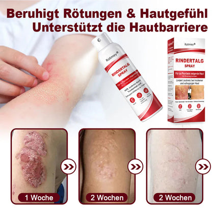 Rolimey® Rindertalg-Spray für juckende, schuppige Psoriasis-Haut 1