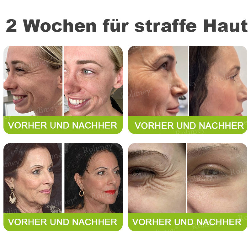 ✅Jetzt jugendliche Haut zurückgewinnen 💫Rolimey® Botox & Vita-A Retinol Shot Falten-Lift Straffungscreme